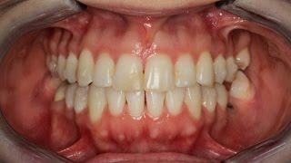 Invisalign Time Lapse [upl. by Voleta23]