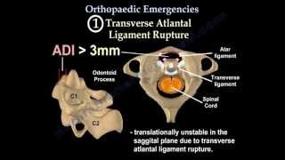 Anterior Cervical Discectomy amp Fusion at C34 C45 amp C56 [upl. by Rayburn]