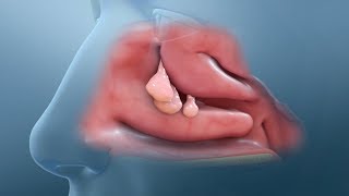 Nasal Polyp Removal Surgery [upl. by Merri]