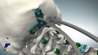 CASPIAN® Occipital Plate Product Animation [upl. by Reynolds90]