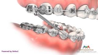 Orthodontic Treatment for Overjet Overbite  Forsus Appliance [upl. by Isia]