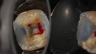 Complete endodontic treatment of a lower first molar step by step [upl. by Senaj]