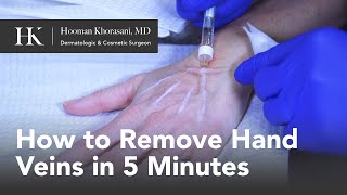 How To Get Rid of Hand Veins in 5 Minutes by Dr Hooman Khorasani [upl. by Uella639]