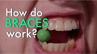 How Do Braces Work [upl. by Annaxor]