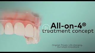 ALLON4 Nobel Biocare Implants Explained [upl. by Hamnet]