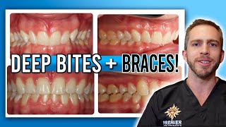 Deep Bite Braces Treatment BEFORE amp AFTER [upl. by Ahsaele]