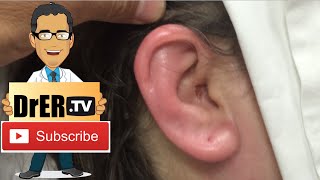 ✅ How To Use Debrox Drops Earwax Removal Aid Review [upl. by Opalina]