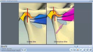 TMJ Disorders [upl. by Fuld]