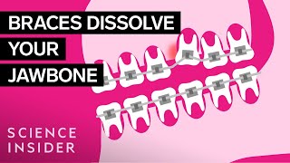 How Do Braces Actually Work [upl. by Isidora]