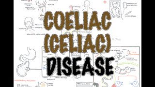 Coeliac Celiac Disease  Overview signs and symptoms pathophysiology diagnosis treatment [upl. by Iorgos]