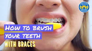 How to Brush with Braces  3 Brushing Tips [upl. by Bala]