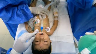 Pediatric Anesthesia Intubation Lessons  Anesthesiologist POV [upl. by Aniakudo]