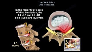 What are the different techniques of Inguinal hernia surgery [upl. by Keiryt357]