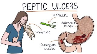 Understanding Stomach and Duodenal Ulcers [upl. by Anirak]