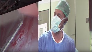 Bladder Instillation with Bruce Kahn MD [upl. by Cirad]