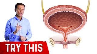 Bladder Cancer Treatment Urinary Diversion  Urology Care Foundation [upl. by Lait]