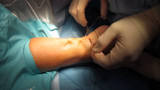 Open Inguinal Hernia Mesh Plug Removal and Repair [upl. by Grindlay]