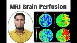 MRI Brain perfusion [upl. by Drewett]