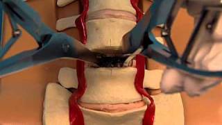 BEST Exercise for a Lower Lumbar Herniated Disc L4 L5 S1 [upl. by Annah]