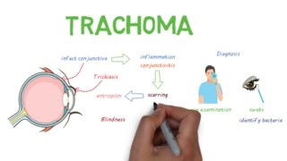 Trichinellosis  Infectious Disease Video Lectures  Medical Education  VLearning [upl. by Neladgam]