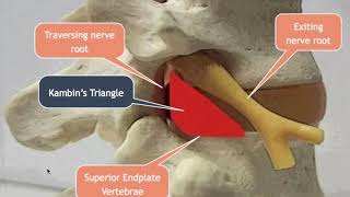 Lumbar Transforaminal Approach for Disc Herniations [upl. by Odilo]