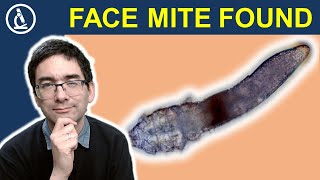 Demodex FACE MITE under the microscope [upl. by Anaiq116]