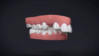 Invisalign® Treatment with Manidublar Advancement [upl. by Eninnej]