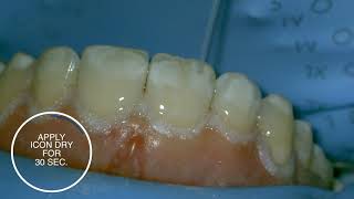 White spot treatment using infiltration with Icon  stepbystep [upl. by Guenzi]