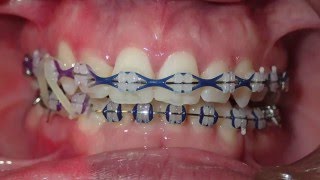 Orthodontic Transformation from Start to Finish [upl. by Ecidnak]