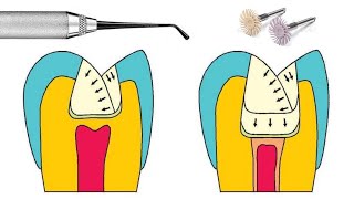 Manipulación de resina dental [upl. by Lapotin907]