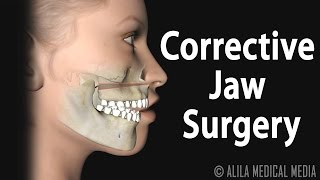 Corrective Jaw Orthognathic Surgery Animation [upl. by Surad627]