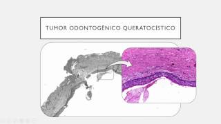 12  TUMORES ODONTOGÊNICOS [upl. by Olnay]