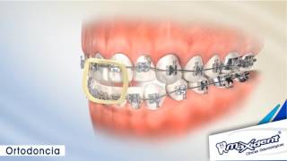 Corrección de mordida y espacios dentales quotOrtodonciaquot [upl. by Herrah]