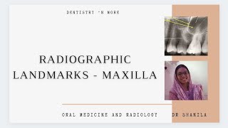 RADIOGRAPHICAL LANDMARKS  MAXILLAKindly use 🎧 [upl. by Acitel884]