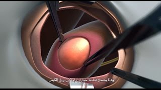 Inguinal Hernia Repair [upl. by Bowles]