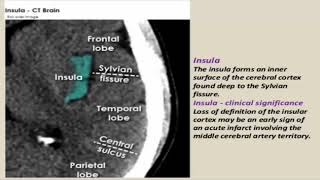 CT brain study step by step [upl. by Casabonne]