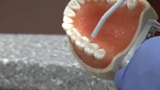 New cavity treatment offers no drilling no filling [upl. by Oinotnaocram]