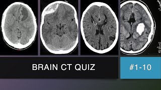 Brain CT Scan Quiz 1  10 [upl. by Ennaihs]