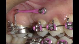 Mesialização de molar com miniimplantes [upl. by Abe]