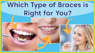 Types Of Orthodontic Treatment  Which Braces Are Right For You [upl. by Arac]