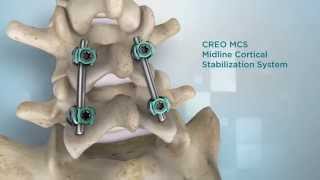 Globus Medical CREO MCS™ [upl. by Ycal]