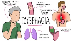 Dysphagia  Oropharyngeal amp Esophageal Dysphagia CausesDifferential Diagnosis Signs Treatment [upl. by Anitsahs814]