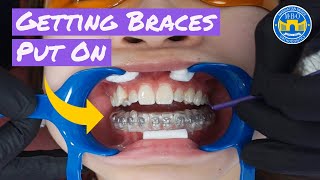 Process of Getting Braces [upl. by Shaffert]