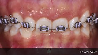 Braces timelapse  Deep Bite progress [upl. by Enialem]