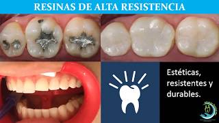 Resinas dentales de alta resistencia [upl. by Allak]