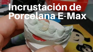 INCRUSTACIÓN Dental de Porcelana👅 EMax Onlay dentaltip [upl. by Nalaf]