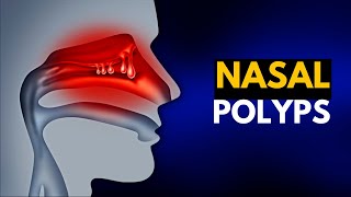 NASAL POLYPS Causes SIgns and Symptoms Diagnosis and Treatment [upl. by Oigufer]