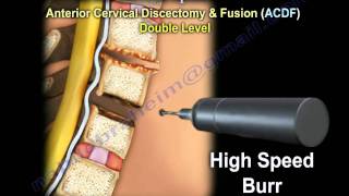 Cervical Spine Decompression And Fusion   Everything You Need To Know  Dr Nabil Ebraheim [upl. by Iras]