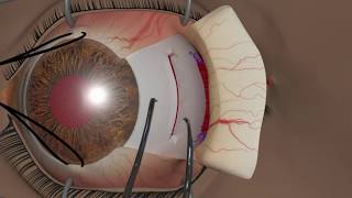 Strabismus surgery Recession [upl. by Urd335]