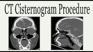 CT cisternogram procedure [upl. by Loralie]